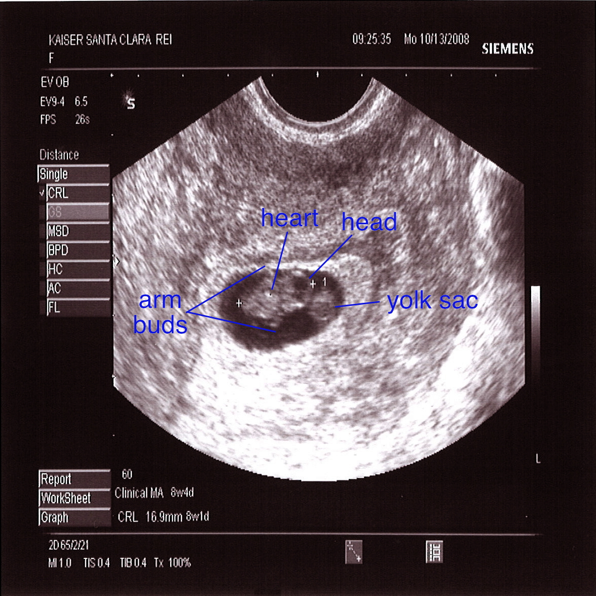 Weeks 4 days ultrasound 4 4 weeks